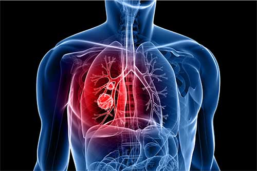 机器学习结合呼出气挥发性有机物分析建立肺癌诊断新框架